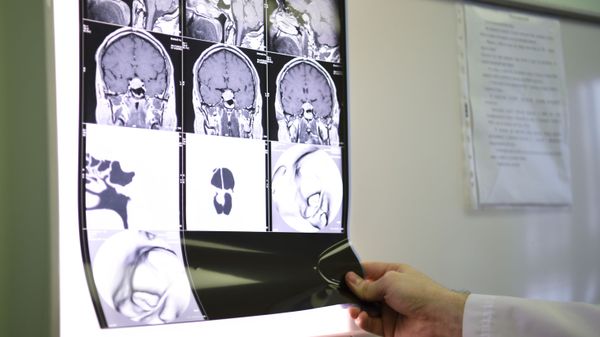 Медицинский работник смотрит снимки пациента помещенного в модернизированный аппарат Гамма-нож в центре радиохирургии НИИ СП имени Н. В. Склифосовского в Москве. Эта радиотерапевтическая нейрохирургическая система используется при лечении доброкачественных и злокачественных опухолей и сосудистых мальформаций в полости черепа