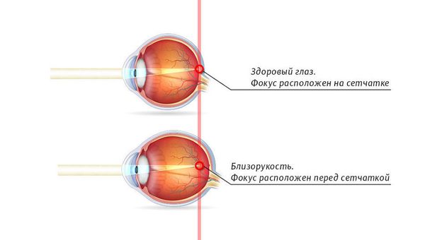Удлиненное глазное яблоко вызывает близорукость